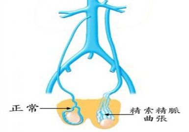 精索静脉曲张治疗